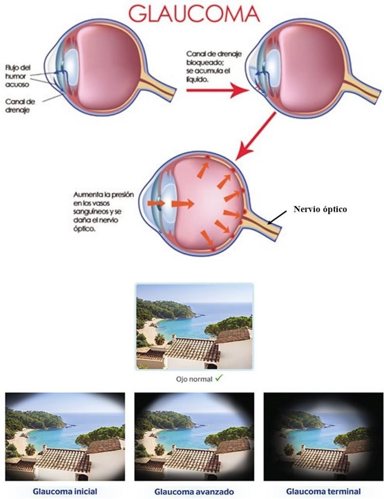Imagen El Glaucoma, la Pérdida Silenciosa de la Visión